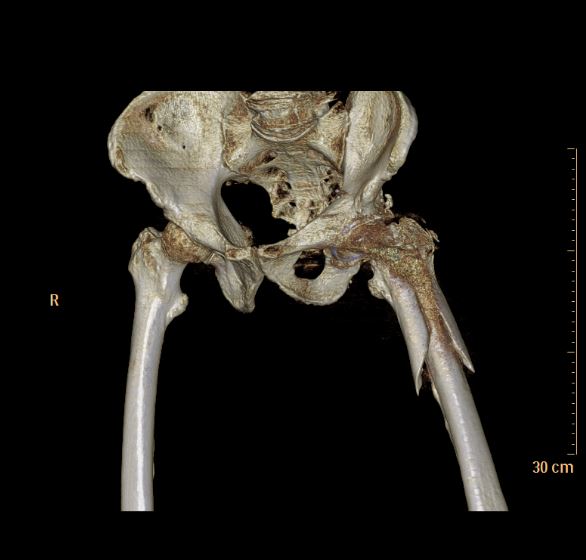 Complessa frattura periprotesica dell'anca