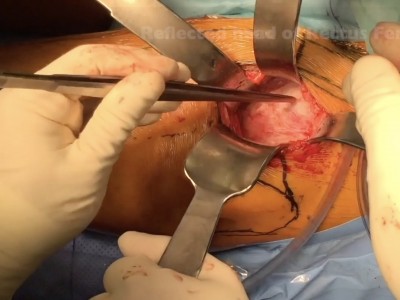 L'Accesso Anteriore Diretto mini Invasivo all'anca (video)