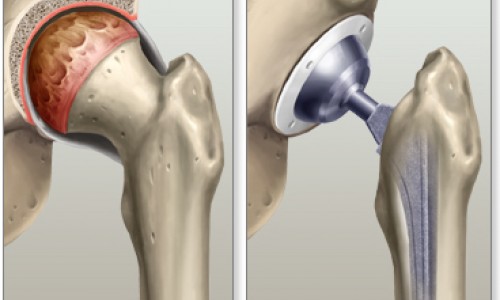 La protesi totale d'anca