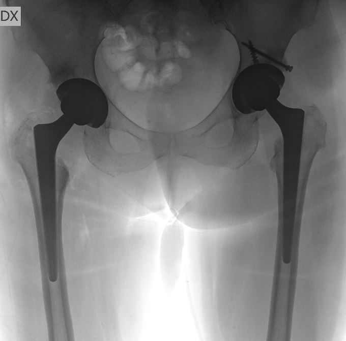 La Protesi all'anca displasica 