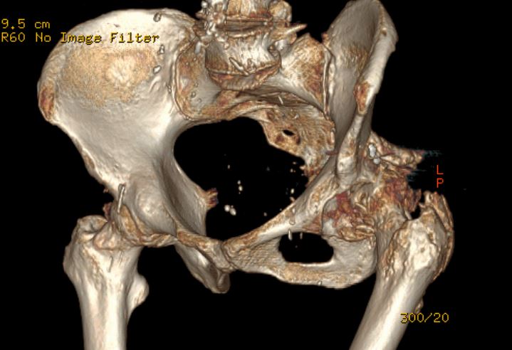 Protesi complessa dell'anca
