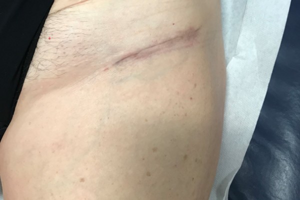 La Protesi d'anca con tecnica mini-invasiva e "Bikini"