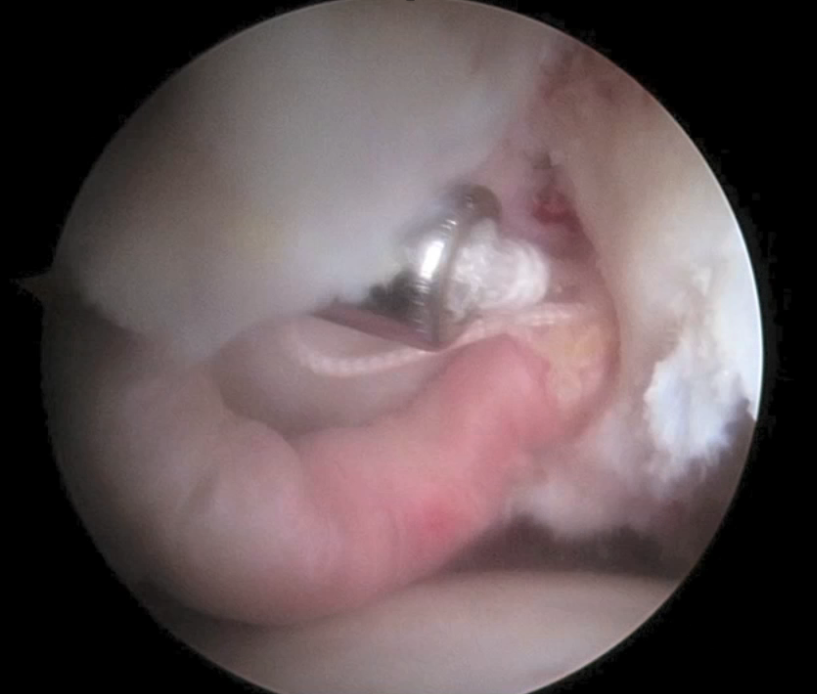 Trapianto di Labbro Acetabolare dell'anca in artroscopia
